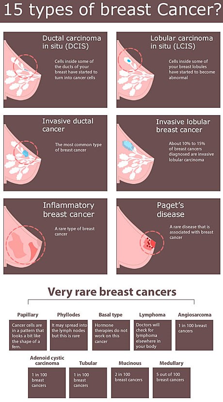 15 types of Breast cancer