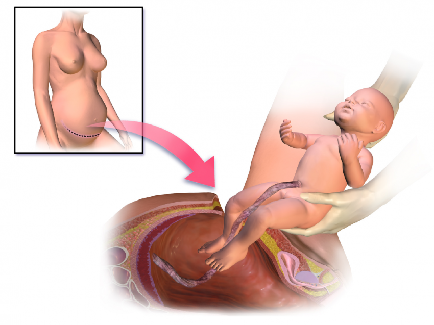 Why are Caesarean rates increasing?